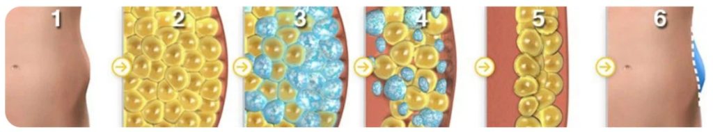 Hoe werkt het - Cryolipolyse - Vet bevriezen